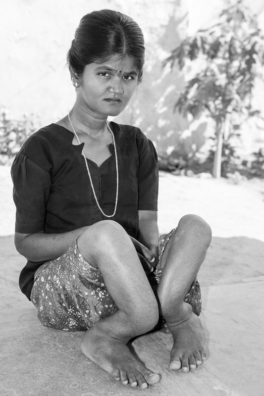 A young lady debilitated by severe skeletal fluorosis due to consumption of fluoride-rich groundwater in a village in Nalgonda district, Telangana